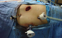 Best Kidney transplant Surgeon india, best kidney transplant hospital in punjab, Best urologist, super Specialist kidney surgeon chandigarh, mohali, panchkula, leading Uro oncologist ludhiana, HP, Baddi, Punjab, himachal, haryana